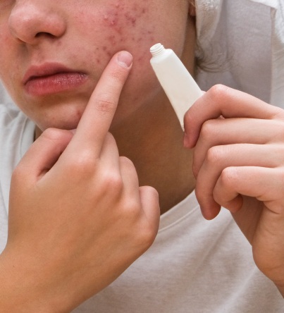 pimple treatment
